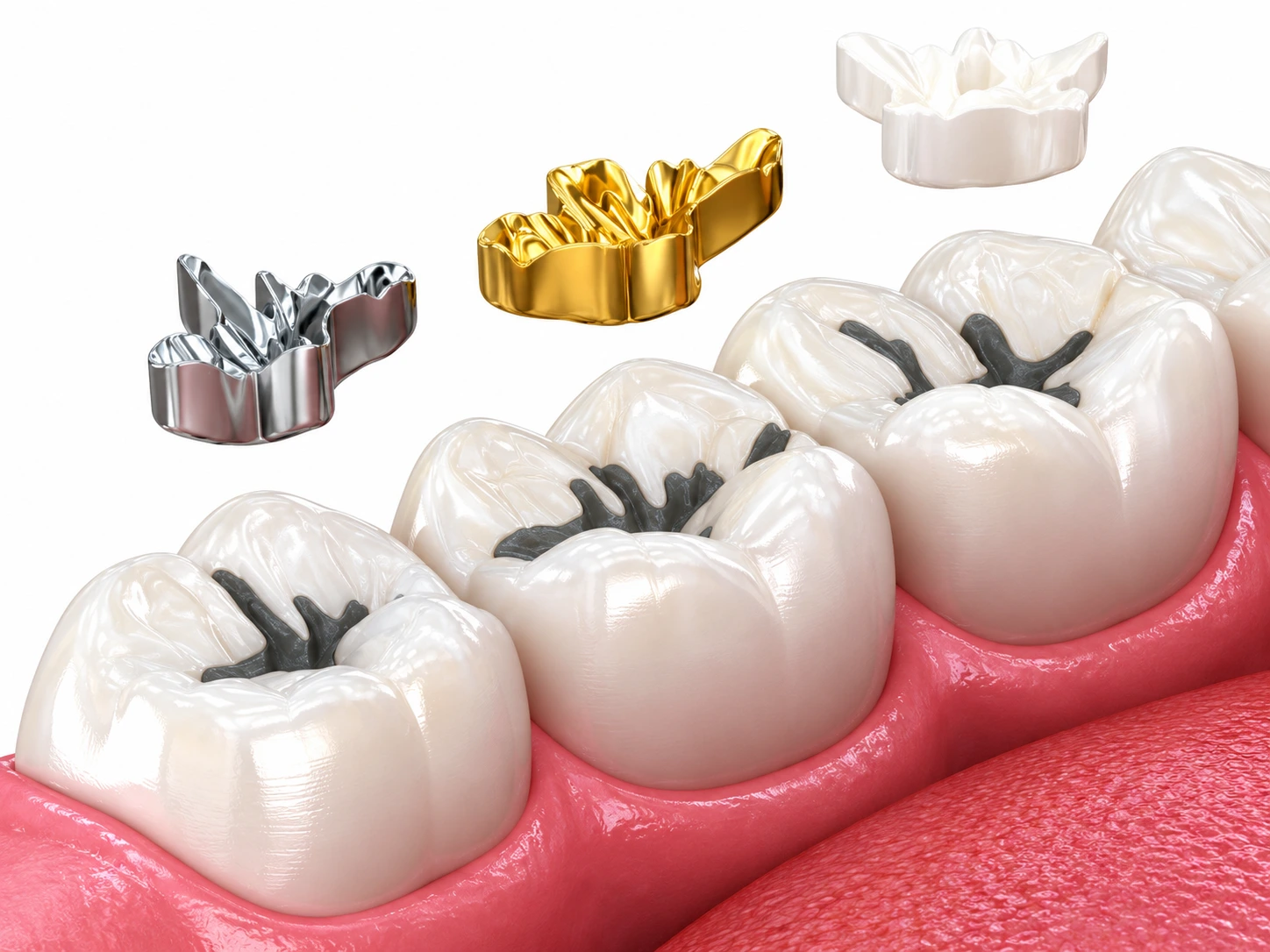 dental filling cost in jb