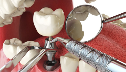 Tooth Extraction in Johor Bahru